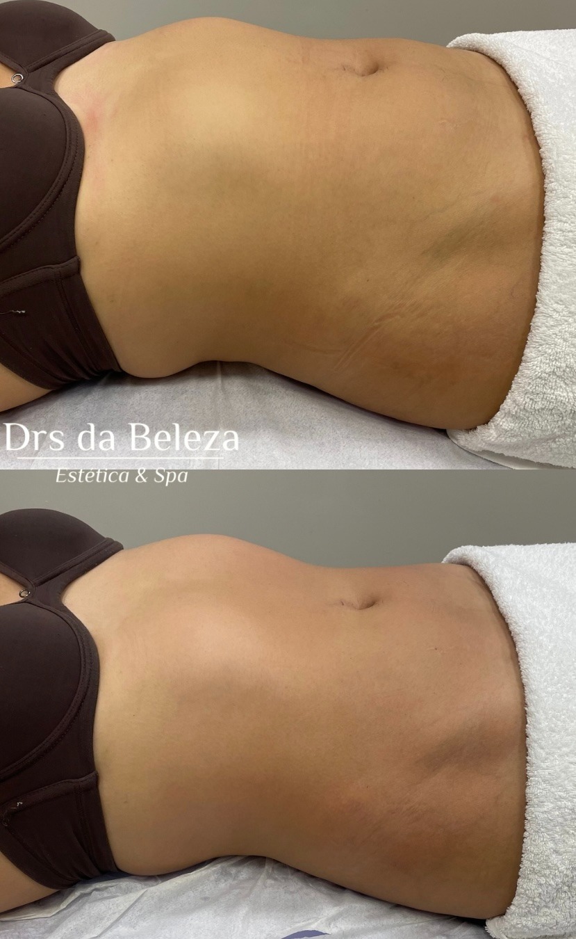 Antes e Depois 1