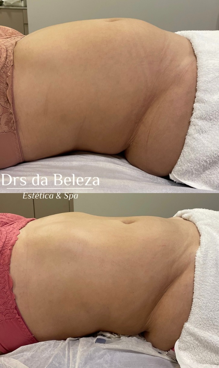Antes e Depois 3