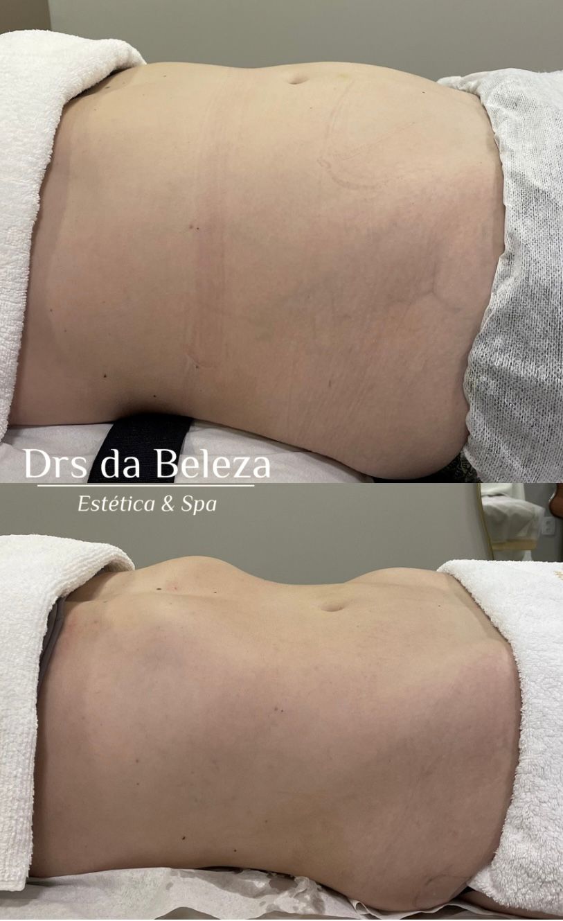 Antes e Depois 4