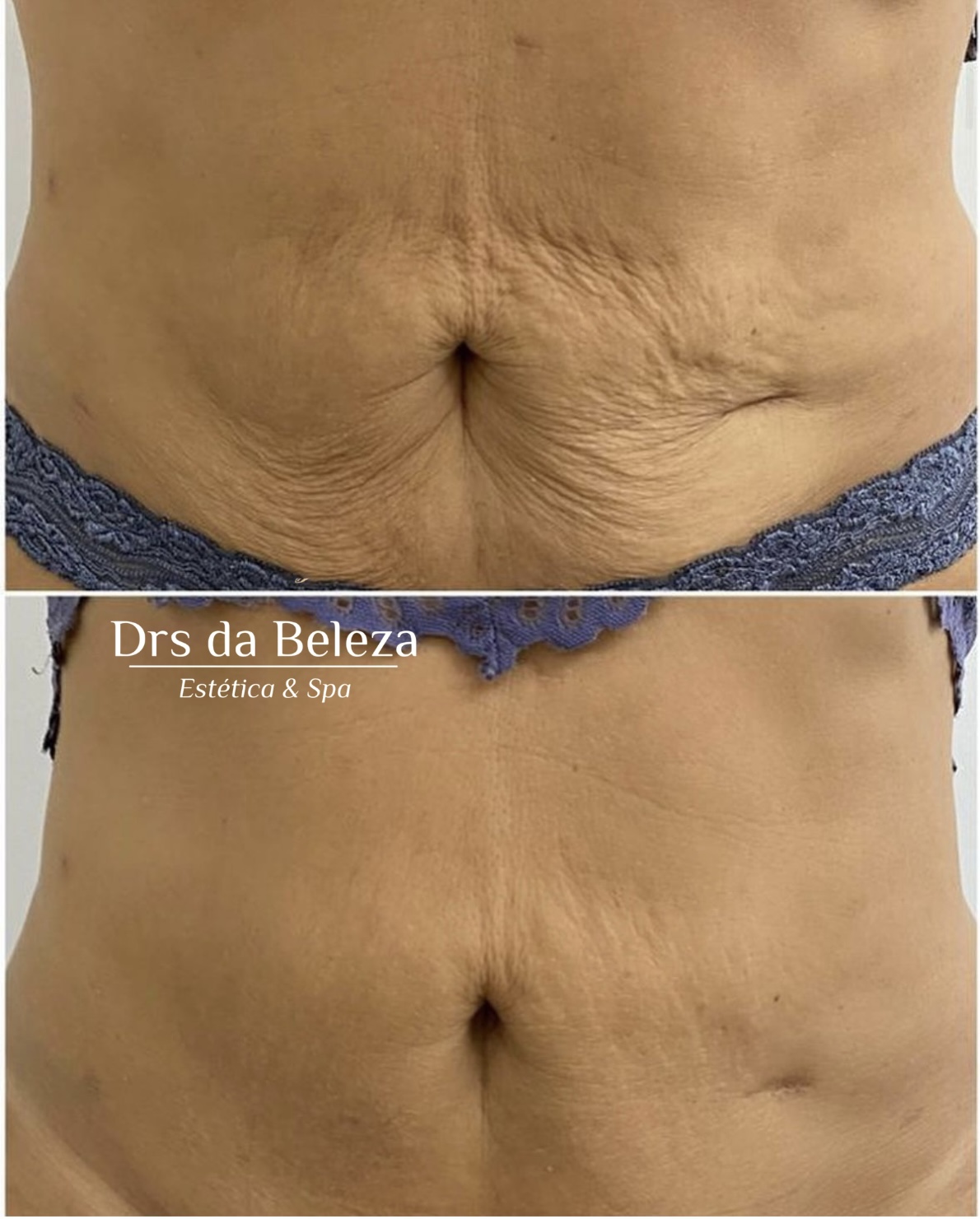 Antes e depois de tratamento Lavieen na região abdominal