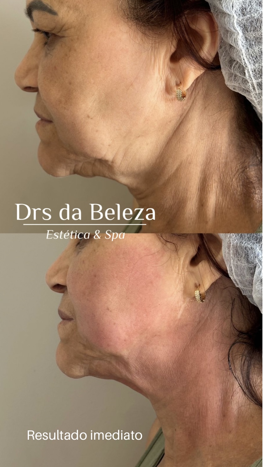 Antes e depois de tratamento Lavieen no rosto e pescoço