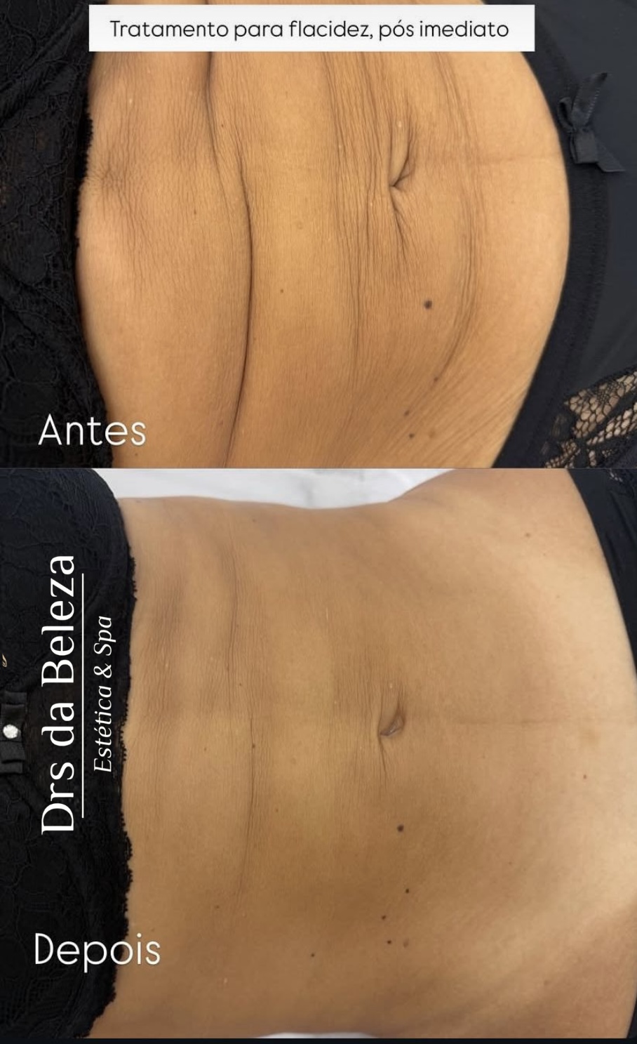 Antes e depois de tratamento Lavieen para flacidez abdominal