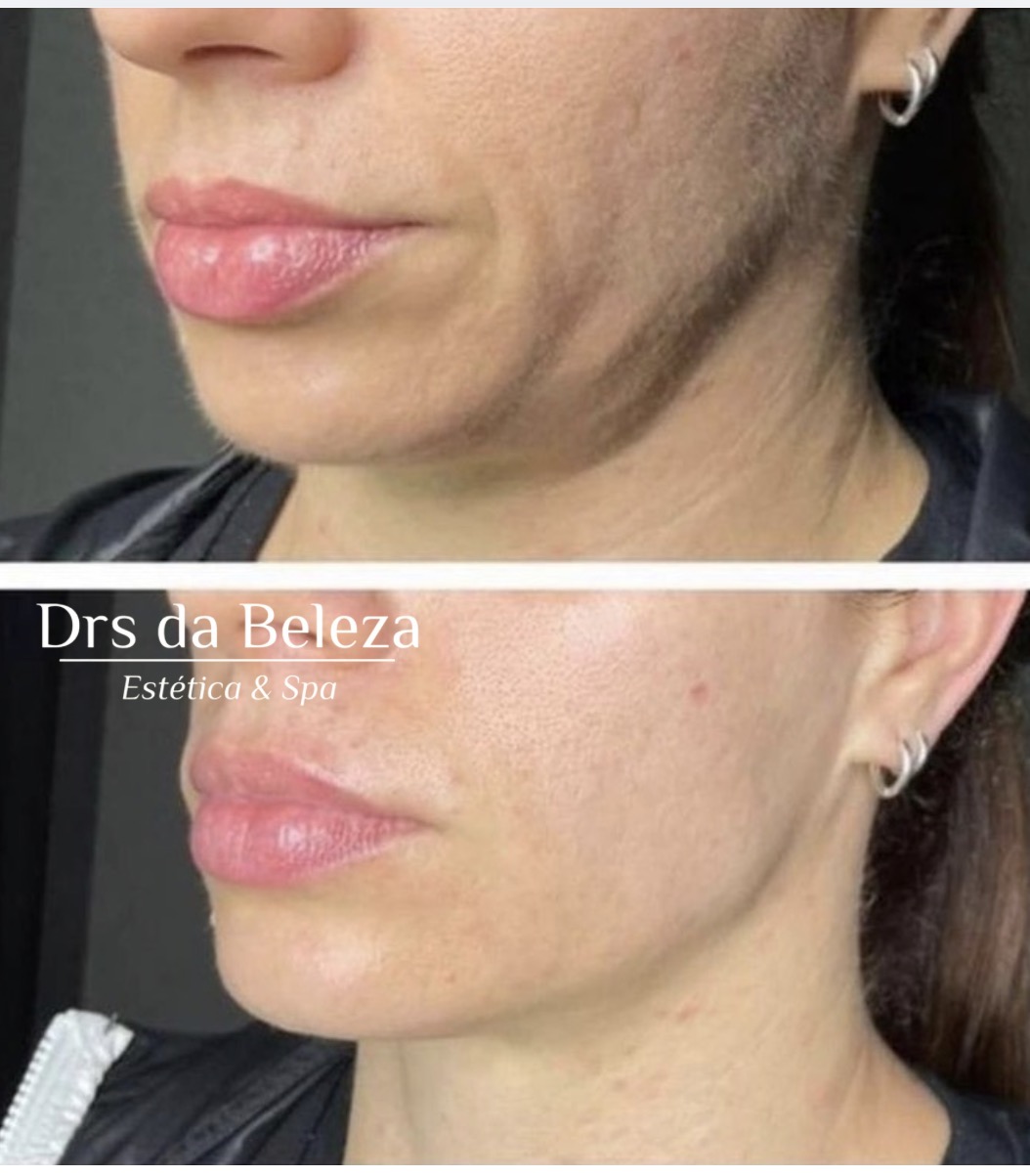 Antes e depois de tratamento Lavieen no contorno facial