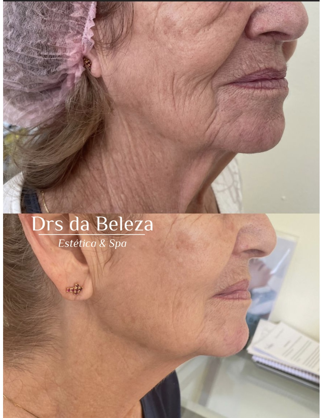 Antes e depois de tratamento Lavieen no rosto e pescoço de perfil